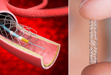 El reino del muelle en el corazón: el ‘stent’ es el implante del que más se abusa en España