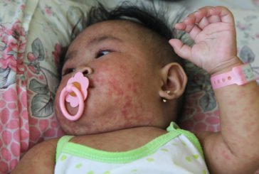 Filipinas está luchando contra uno de los peores brotes del sarampión del mundo #5